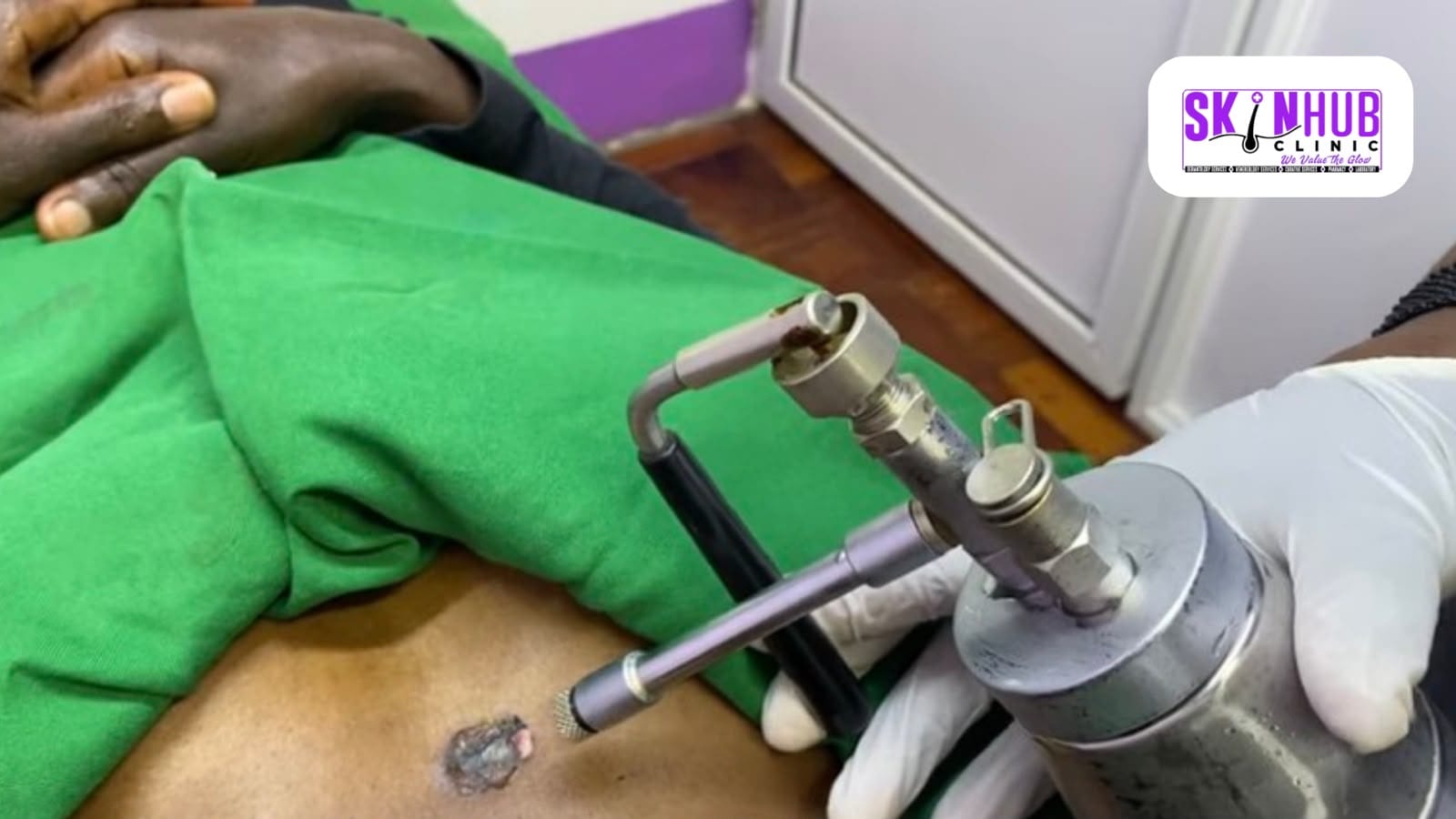 A clinician applying a liquid nitrogen cryotherapy probe to a small skin lesion